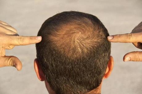 florida hair transplant clinic