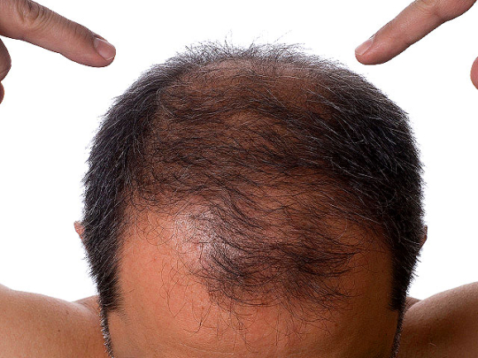 pennsylvania hair transplant clinic